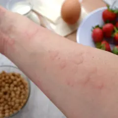Ręka z wysypką, obok miseczka soi, jajko, mleko i truskawki. Może to być objaw alergii krzyżowej.