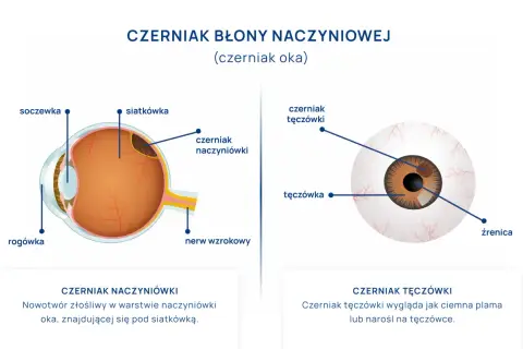 Schemat oka z zaznaczonym czerniakiem naczyniówki i czerniakiem tęczówki.