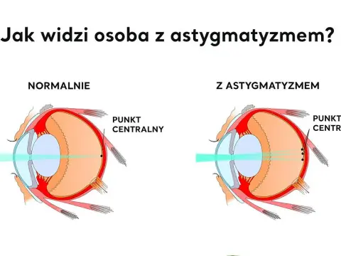 Cylindry w soczewkach: co to jest i jak wpływają na wzrok?