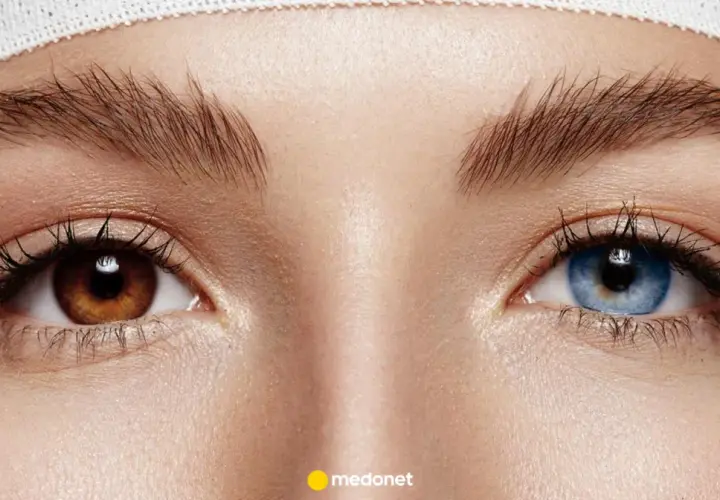 Oczy z heterochromią: jedno brązowe, drugie niebieskie. Widać delikatne zmarszczki i opaskę na głowie.