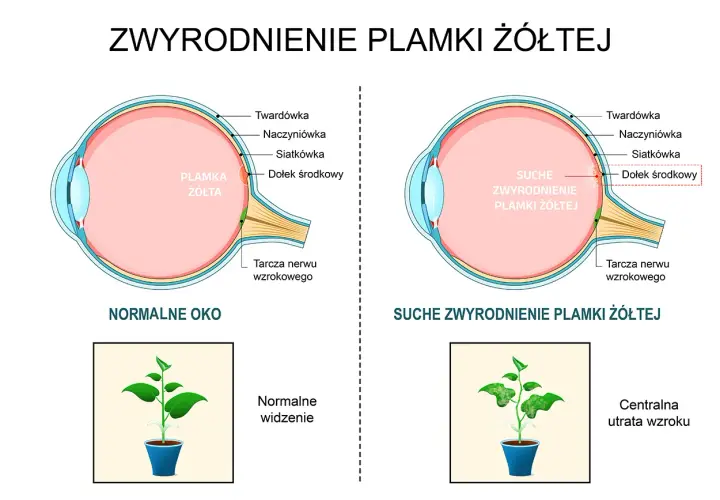 Porównanie zdrowego oka z plamką żółtą i oka z suchym zwyrodnieniem plamki żółtej, pokazujące utratę centralnego widzenia.